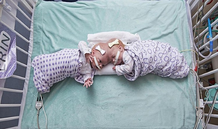 Gêmeas Erin e Abby Delaney no Hospital Infantil da Filadélfia, em setembro de 2016 I Foto: AP
